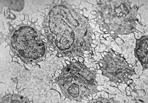 M,38y. | blood - hairy cell leukemia M,38y. | blood - hairy cell leukemia